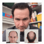 Restore Confidence with a Trusted Hair Transformation in Kent