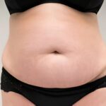 Paramedical Scar Treatment in Dubai | Skincamouflage.ae