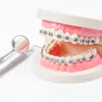 Invisalign Price Range: What to Expect UK