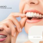 Implantes dentales precio Pozuelo | Clínica Vilar Sancho