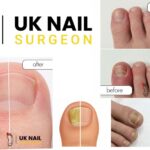 24 Hour Nail Surgery: Fast, Safe and Local Anaesthetic