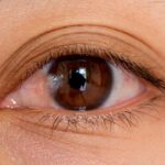 Surgery for Pterygium: Safe, Effective Options in UK Care