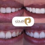 علاج رائحة الفم الكريهة: حلول فعالة ودوام الثقة بالنَفَس المنعش