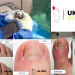 Emergency Nail Surgery 24/7: Fast, Local Anaesthetic Care