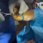 Find Toenail Removal Near Me – Same-Day Safe, Gentle Care